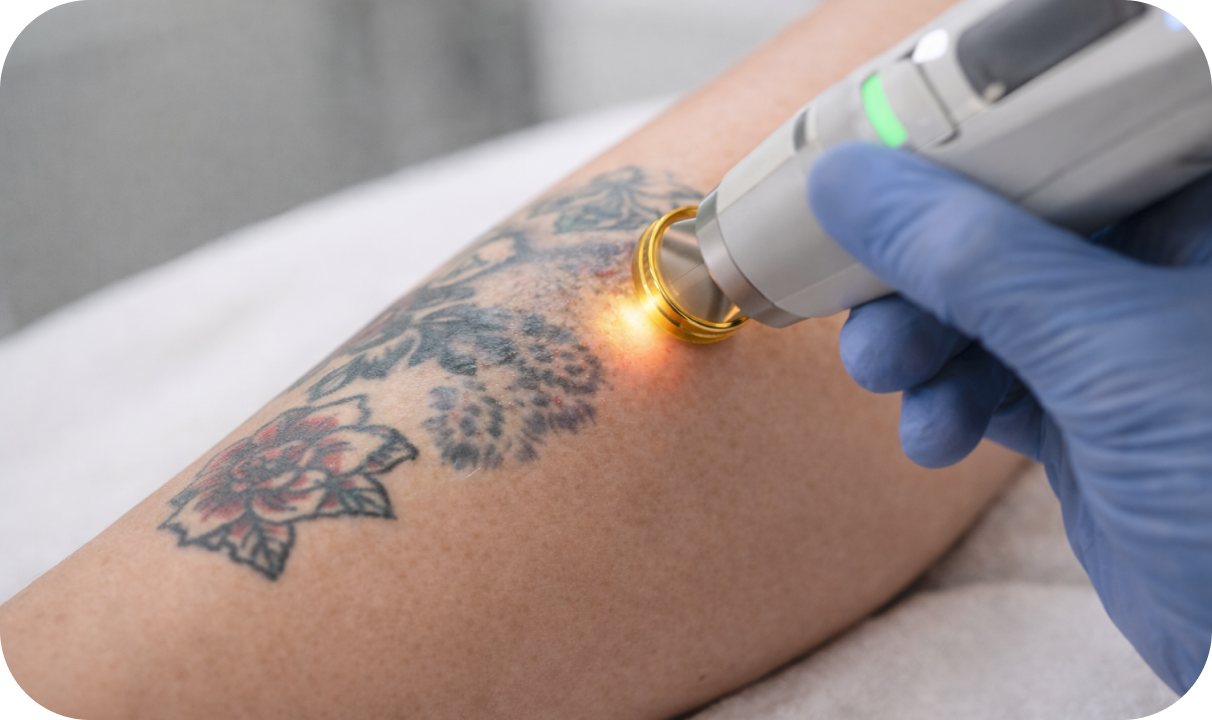 Borrado de Tatuajes