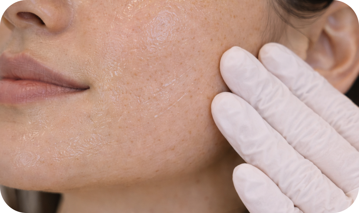 Botox para Bruxismo